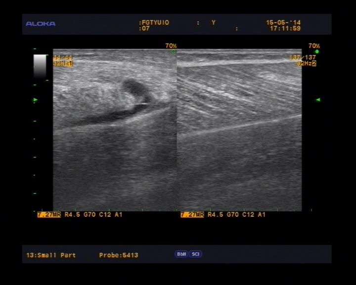 Частичный разрыв медиальной головки икроножной мышцы (на левой половине снимка).