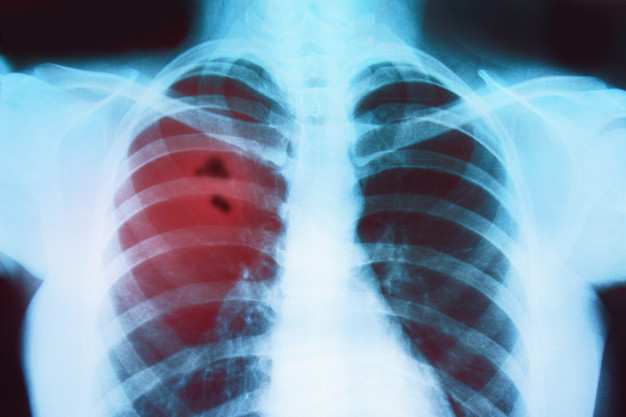 Снимок легких при рентгене в Виннице