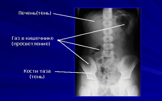 Признаки газа в кишечнике при рентгене брюшной полости