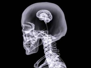 X-ray small brain #2
