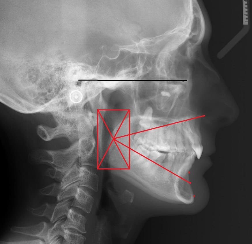 Рентгенівський знімок скронево-нижньощелепних суглобів