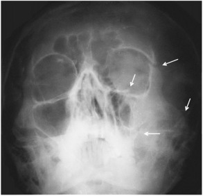 Рентгеновский снимок скуловой кости