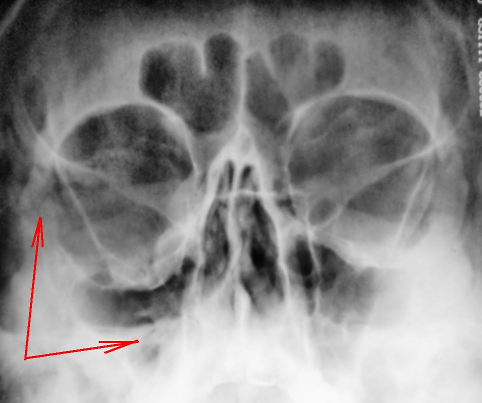 Рентгенівський знімок очниць